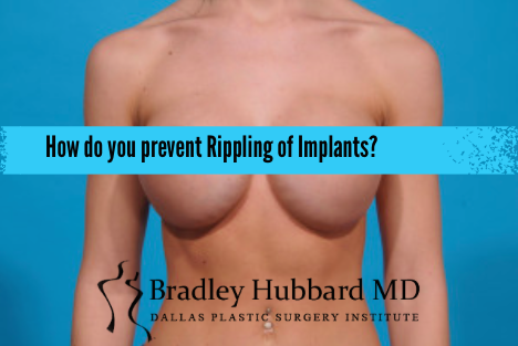 What is Breast Implant Rippling? | Is Implant Rippling Bad or Normal?
