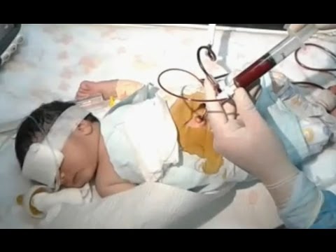 Double Volume Exchange Transfusion Clinical Pathway — ICU | Children's Hospital of Philadelphia