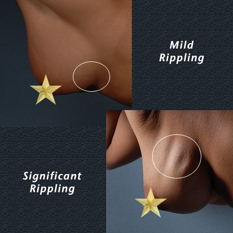What is breast implant rippling? - The American Board of Cosmetic Surgery