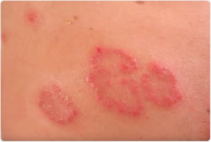 Nummular Eczema: Causes and How to Get Rid of It