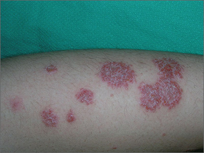 Nummular Dermatitis Condition, Treatments and Pictures for Children - Skinsight