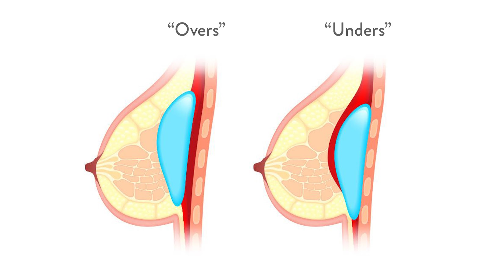 Breast Implant Rippling Houston | Implant Wrinkling